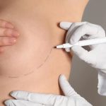 Kilo Alıp Vermek Meme Estetiği Sonuçlarını Nasıl Etkiler?